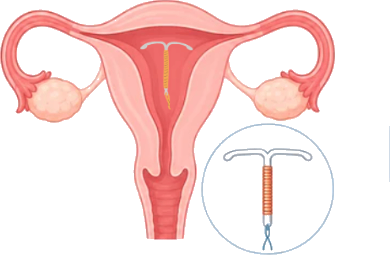 IUD Tembaga (AKDR)